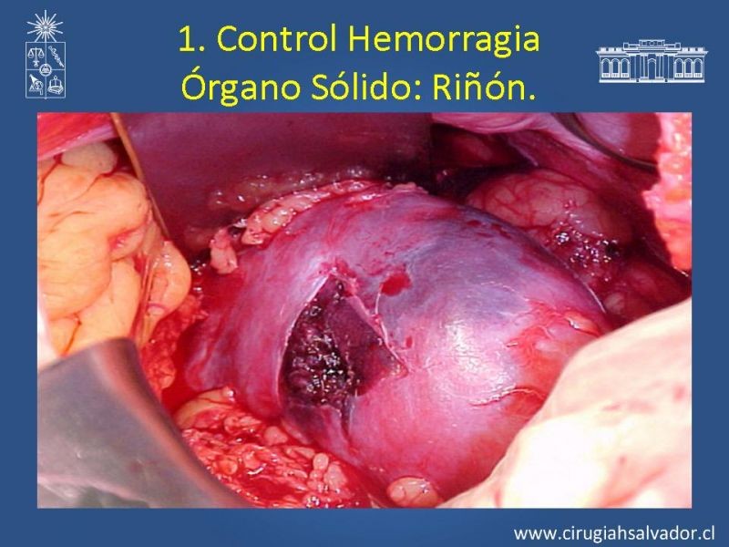 Diapositiva 43 de Damage Control Surgery (técnica quirúrgica) pt. 1