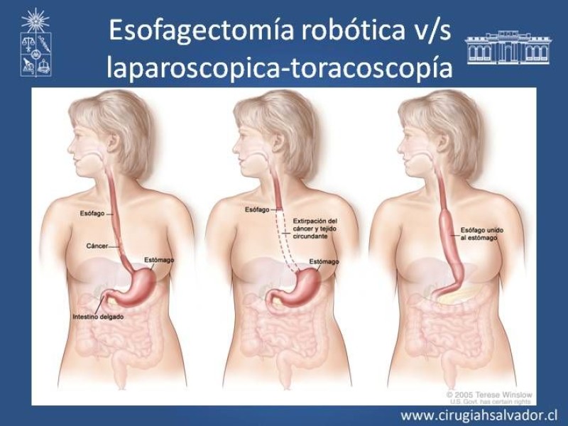 Diapositiva 11 de Robótica en Cirugía Digestiva y Bariátrica