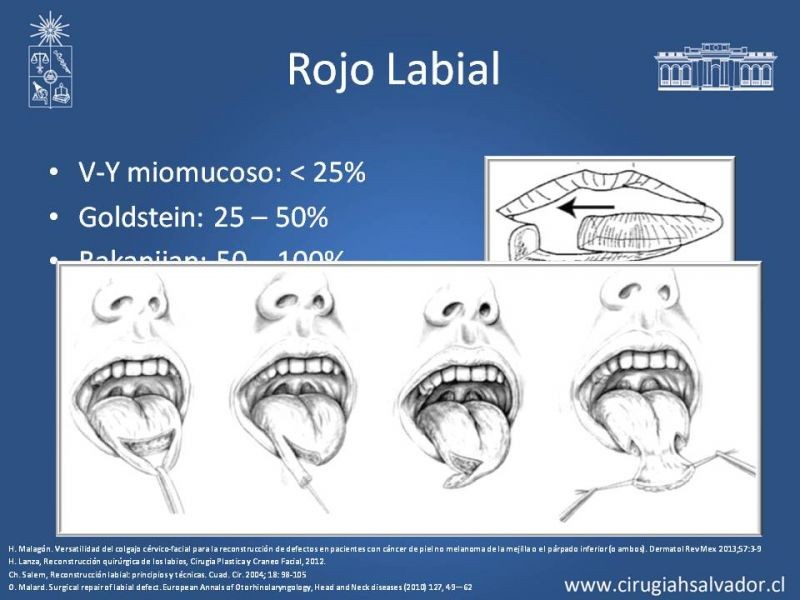 Diapositiva 9 de Reconstrucción peribucal