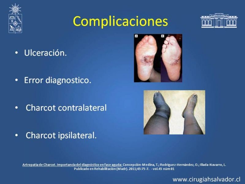 Diapositiva 25 de Diagnostico y manejo de artropatia de Charcot