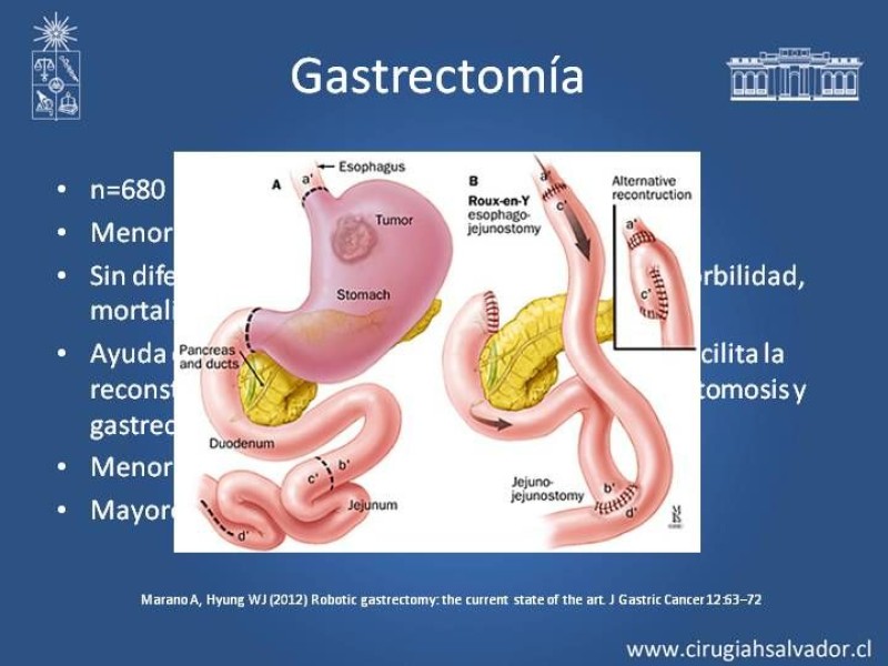 Diapositiva 12 de Robótica en Cirugía Digestiva y Bariátrica