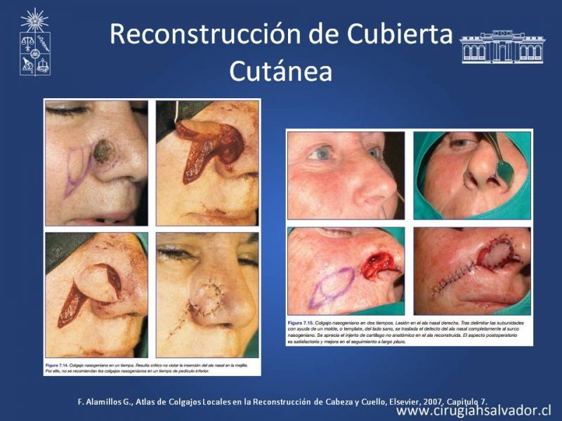 Diapositiva 20 de Reconstrucción Nasal
