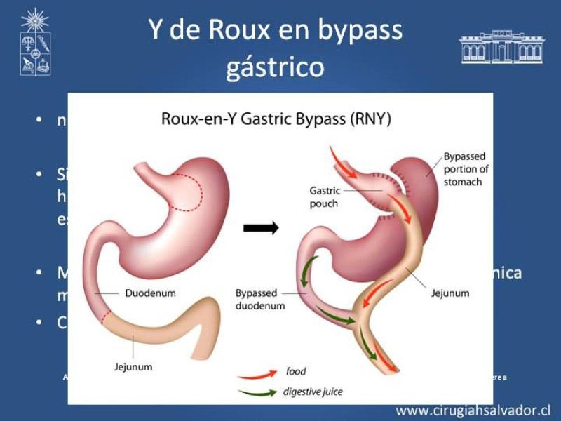 Diapositiva 14 de Robótica en Cirugía Digestiva y Bariátrica