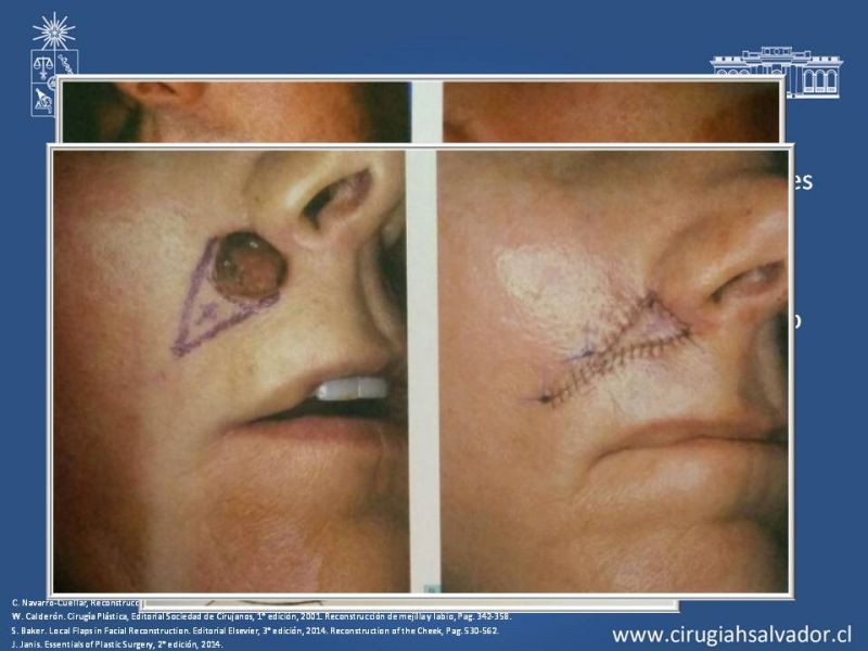 Diapositiva 30 de Reconstrucción peribucal