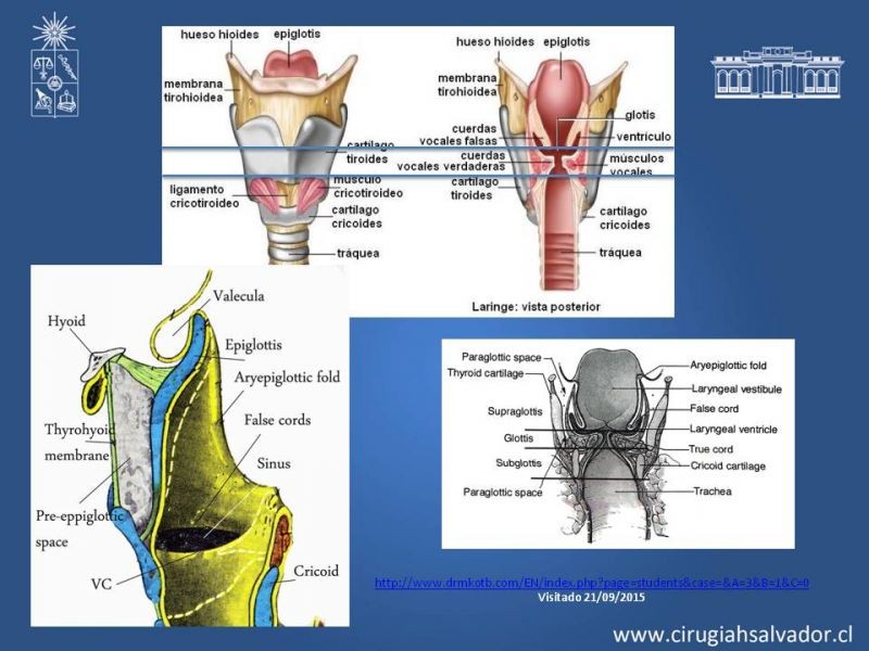 Diapositiva 3 de Cáncer de Laringe