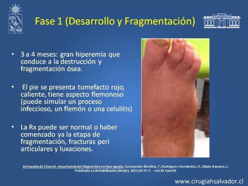 Diapositiva 19 de Diagnostico y manejo de artropatia de Charcot