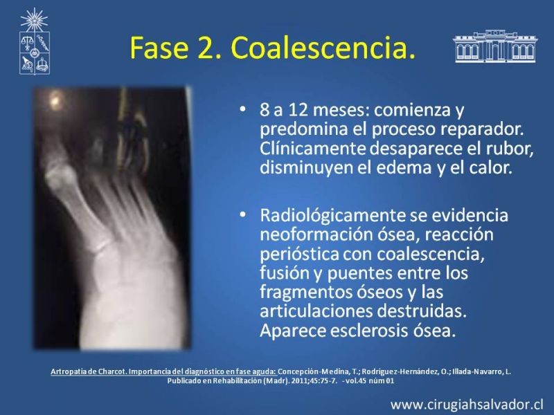 Diapositiva 20 de Diagnostico y manejo de artropatia de Charcot