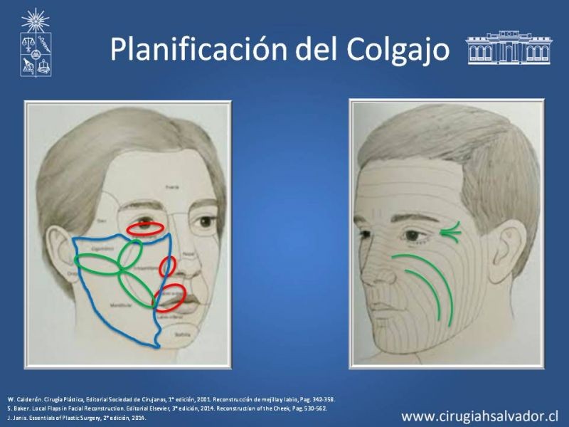 Diapositiva 25 de Reconstrucción peribucal