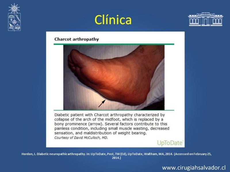 Diapositiva 10 de Diagnostico y manejo de artropatia de Charcot