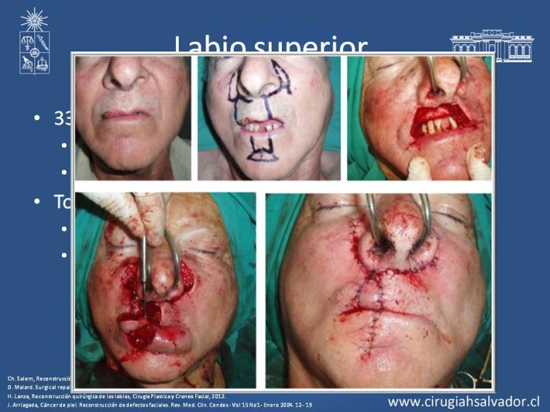 Diapositiva 13 de Reconstrucción peribucal