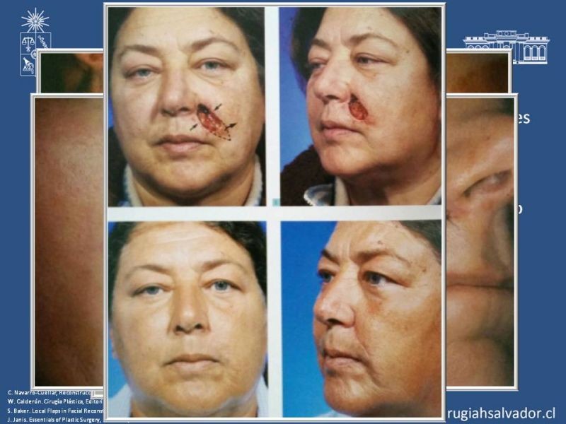 Diapositiva 31 de Reconstrucción peribucal