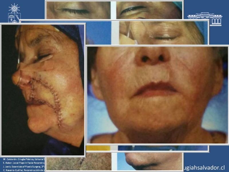 Diapositiva 45 de Reconstrucción peribucal