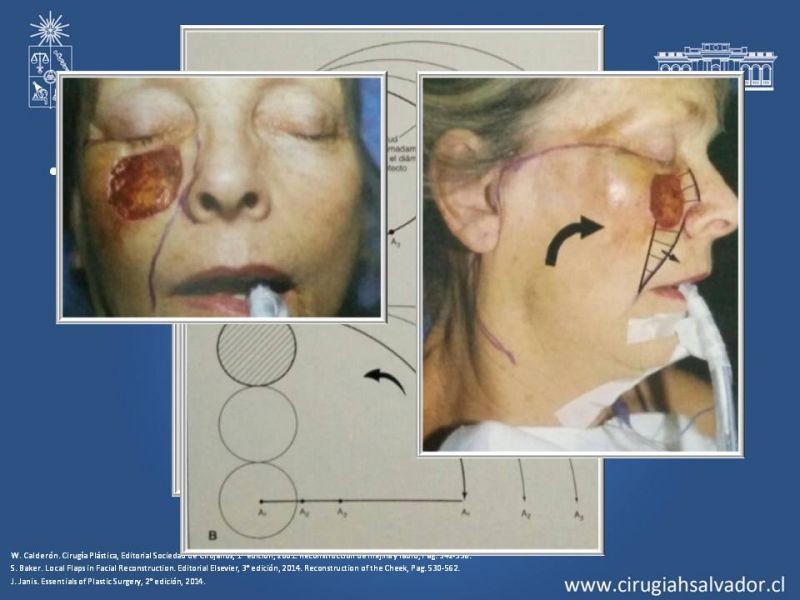Diapositiva 37 de Reconstrucción peribucal