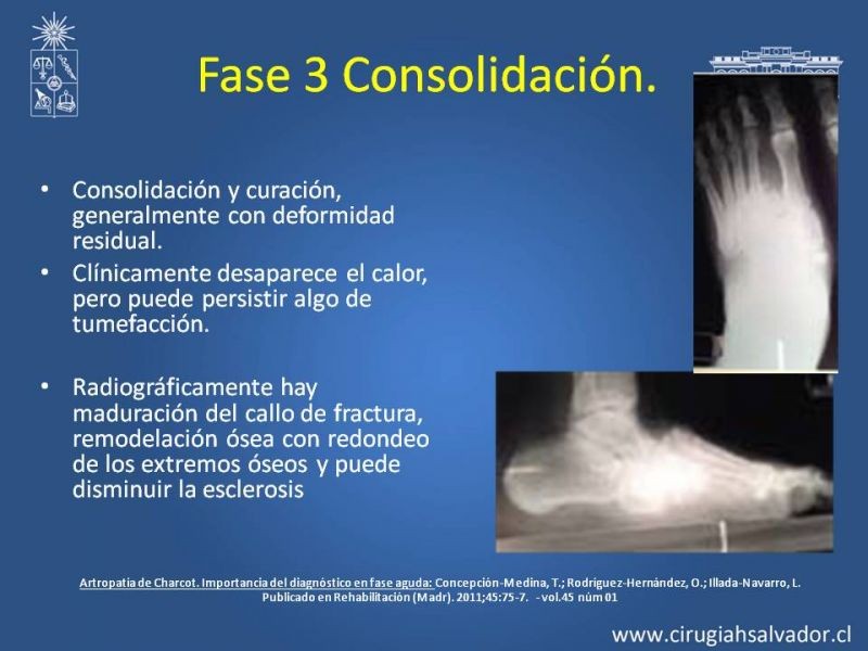 Diapositiva 21 de Diagnostico y manejo de artropatia de Charcot