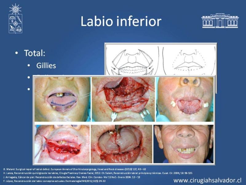 Diapositiva 18 de Reconstrucción peribucal
