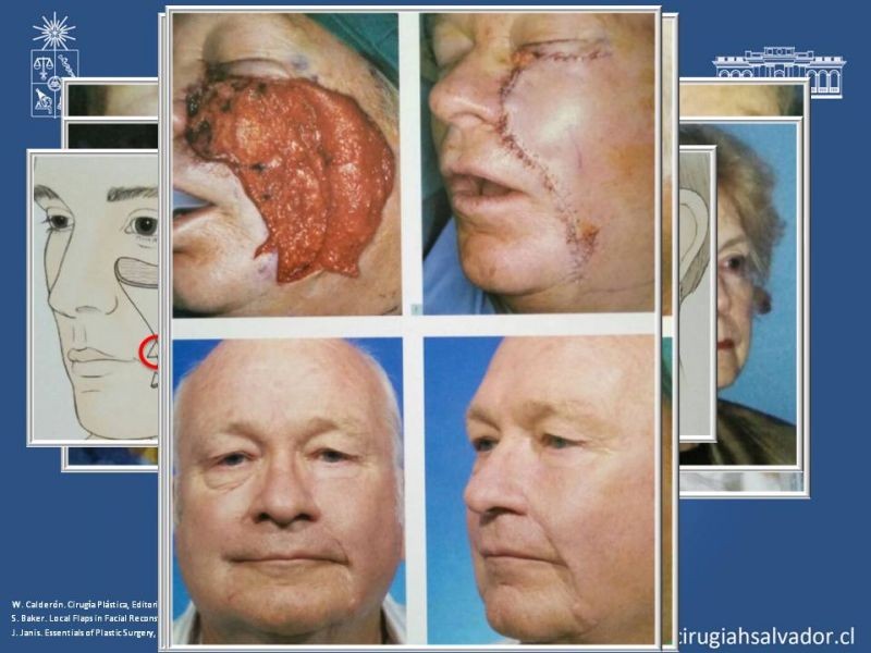 Diapositiva 41 de Reconstrucción peribucal