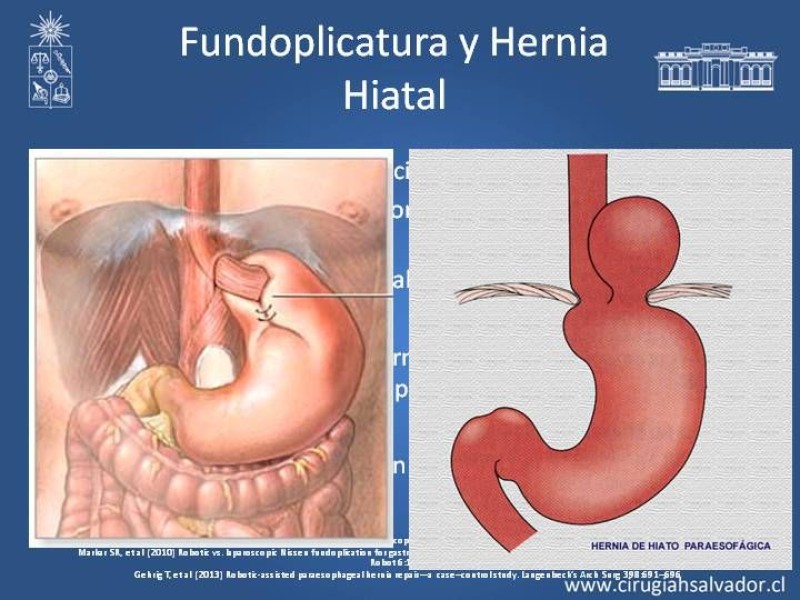 Diapositiva 10 de Robótica en Cirugía Digestiva y Bariátrica