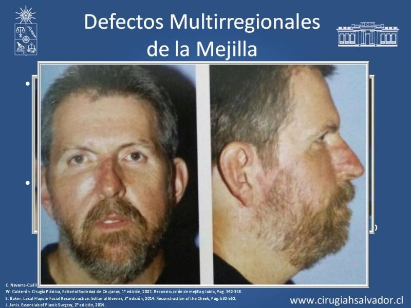 Diapositiva 59 de Reconstrucción peribucal