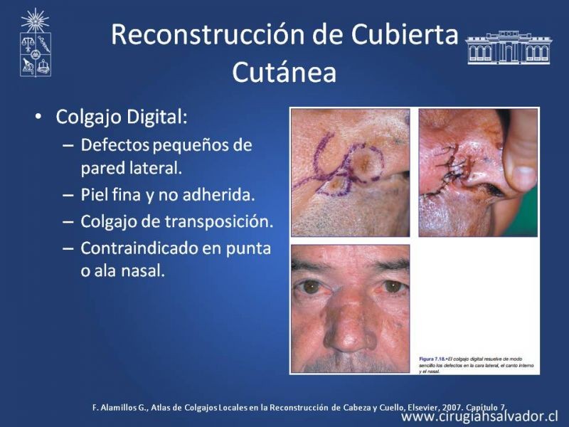 Diapositiva 17 de Reconstrucción Nasal