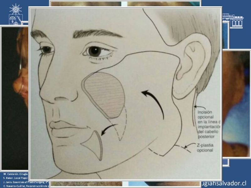 Diapositiva 46 de Reconstrucción peribucal