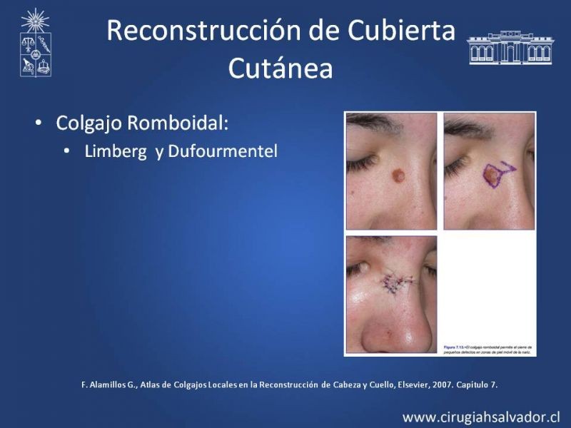 Diapositiva 18 de Reconstrucción Nasal