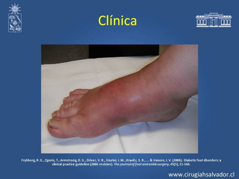 Diapositiva 9 de Diagnostico y manejo de artropatia de Charcot