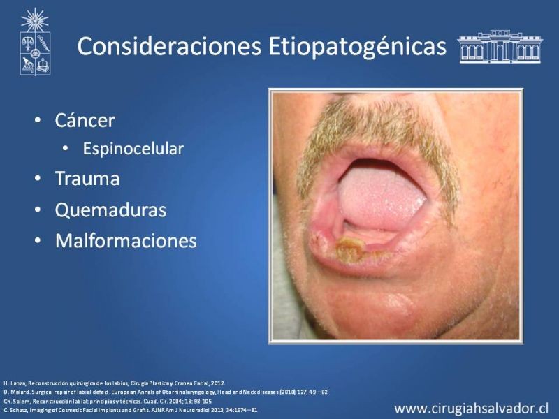 Diapositiva 5 de Reconstrucción peribucal