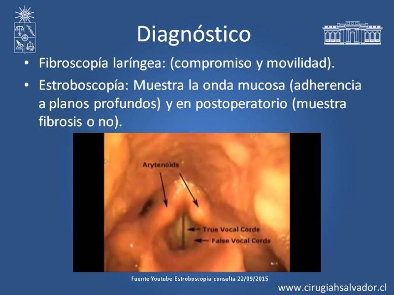 Diapositiva 12 de Cáncer de Laringe