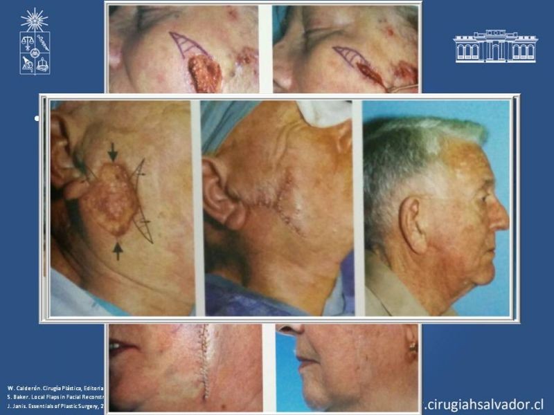 Diapositiva 53 de Reconstrucción peribucal