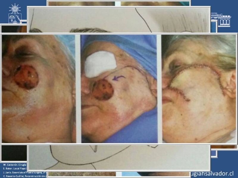 Diapositiva 47 de Reconstrucción peribucal
