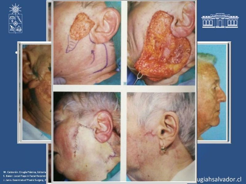 Diapositiva 54 de Reconstrucción peribucal