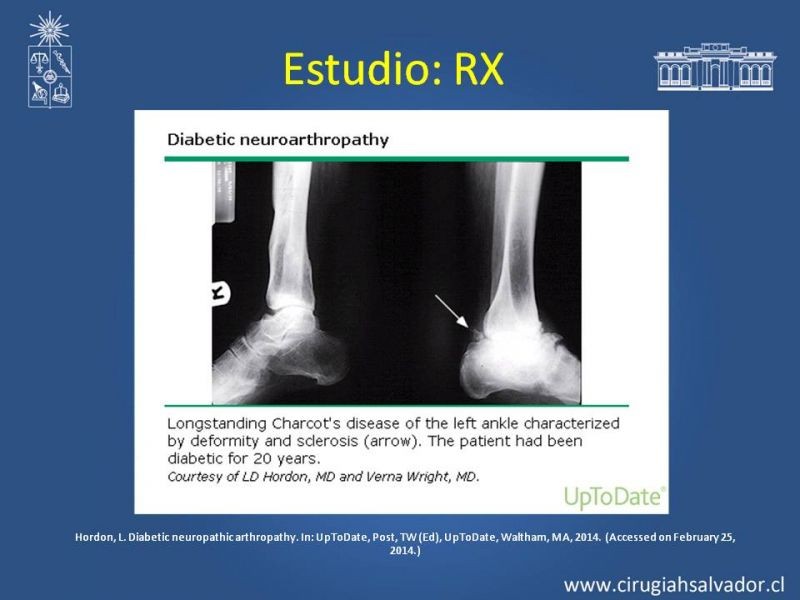 Diapositiva 12 de Diagnostico y manejo de artropatia de Charcot