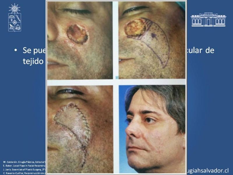 Diapositiva 43 de Reconstrucción peribucal