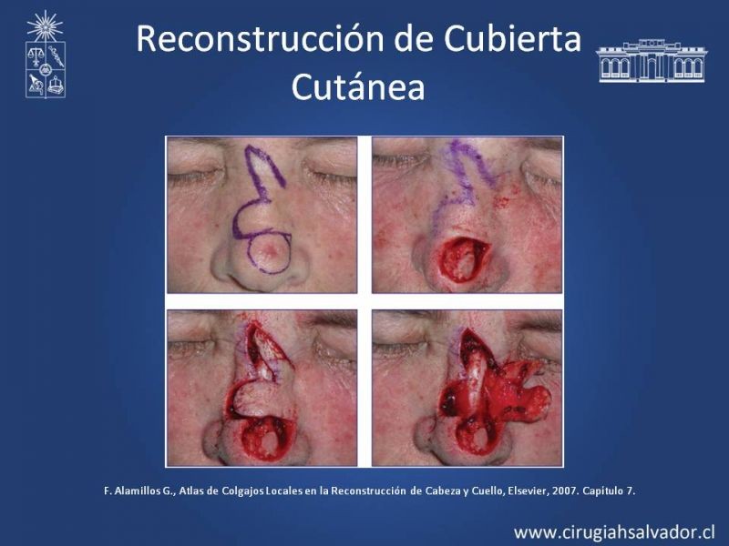 Diapositiva 14 de Reconstrucción Nasal