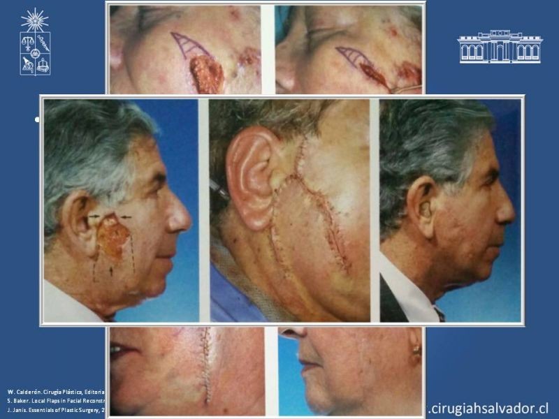 Diapositiva 51 de Reconstrucción peribucal