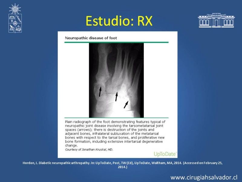 Diapositiva 13 de Diagnostico y manejo de artropatia de Charcot