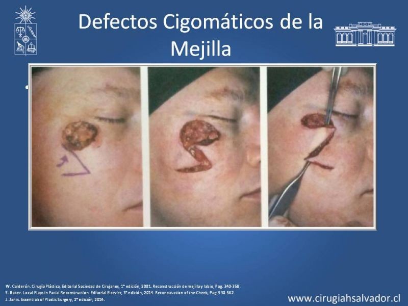 Diapositiva 56 de Reconstrucción peribucal