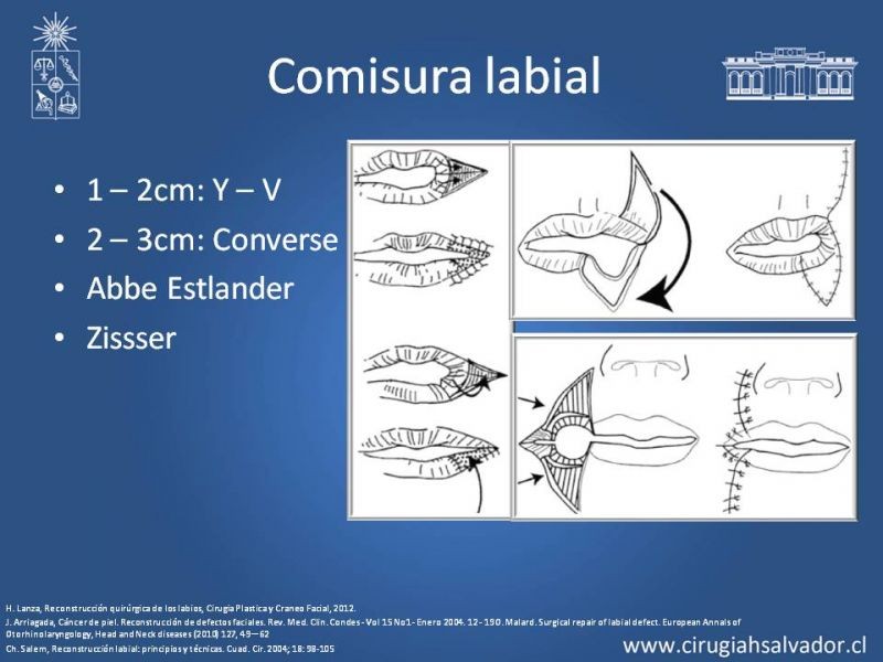 Diapositiva 14 de Reconstrucción peribucal