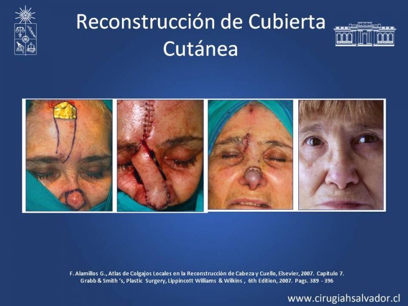 Diapositiva 24 de Reconstrucción Nasal