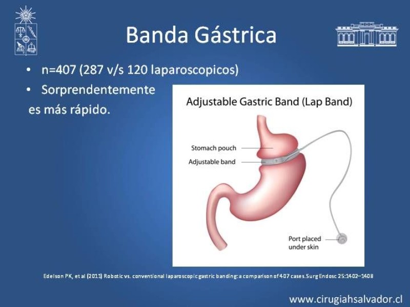 Diapositiva 13 de Robótica en Cirugía Digestiva y Bariátrica