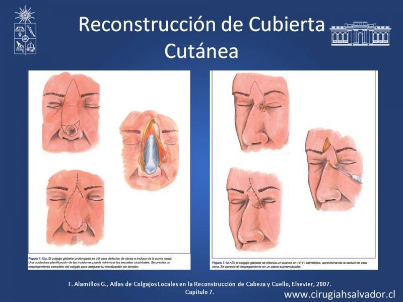 Diapositiva 16 de Reconstrucción Nasal