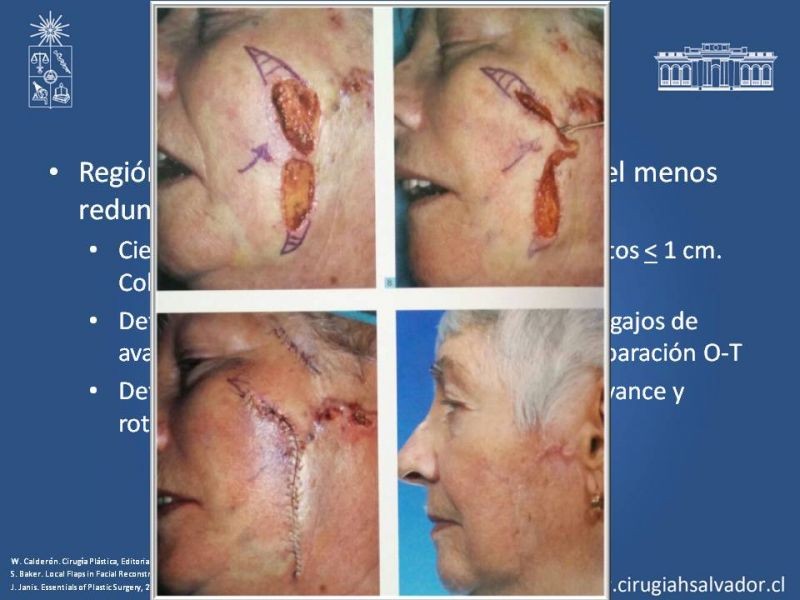 Diapositiva 50 de Reconstrucción peribucal