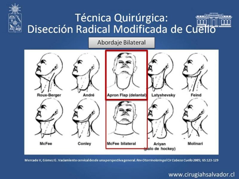 Diapositiva 47 de Técnica quirúrgica en disección cervical radical modificada