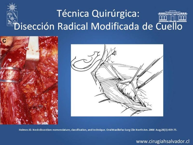 Diapositiva 54 de Técnica quirúrgica en disección cervical radical modificada