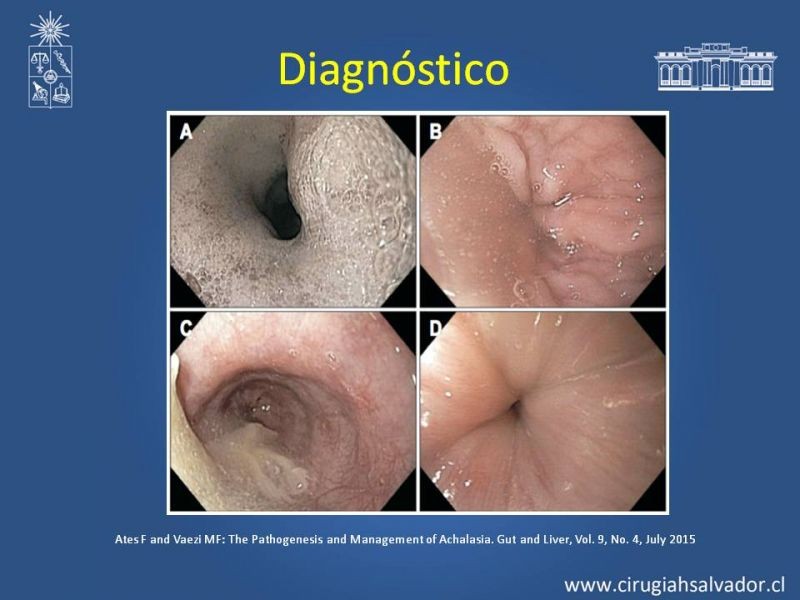 Diapositiva 7 de Manejo Acalasia