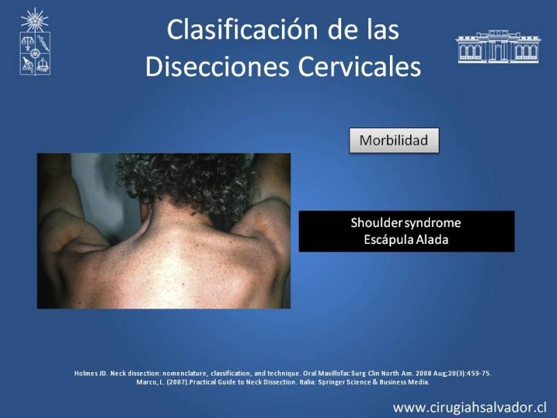 Diapositiva 39 de Técnica quirúrgica en disección cervical radical modificada