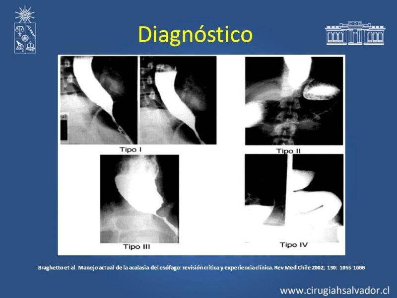 Diapositiva 8 de Manejo Acalasia