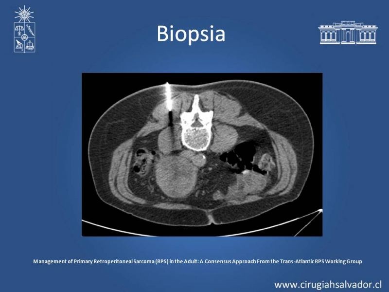 Diapositiva 22 de Tumor Retroperitoneal: Estudio y manejo