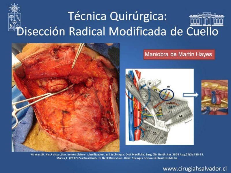 Diapositiva 52 de Técnica quirúrgica en disección cervical radical modificada
