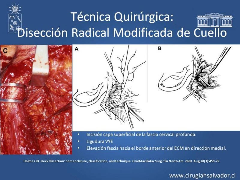 Diapositiva 53 de Técnica quirúrgica en disección cervical radical modificada
